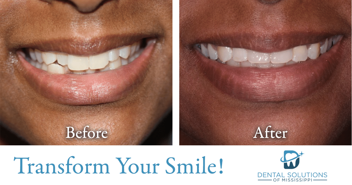 Before and after dental treatment Dental Solutions of Mississippi dentist in Canton MS Dr. Ruth Roach Morgan Dr. Jessica Morgan