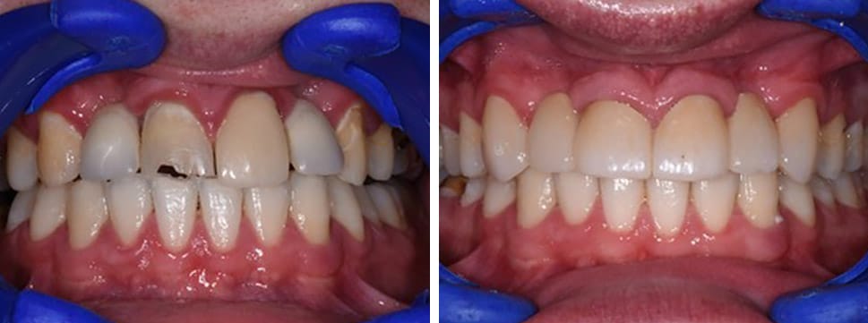 Before and after dental treatment Smile Gallery Dental Solutions of Mississippi dentist in Canton MS Dr. Ruth Roach Morgan Dr. Jessica Morgan