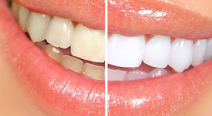 teeth whitening before and after comparison Dental Solutions of Mississippi dentist in Canton MS Dr. Ruth Roach Morgan Dr. Jessica Morgan