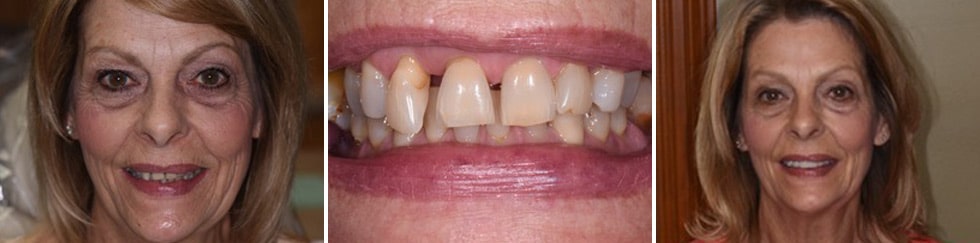 Before and after dental treatment Smile Gallery Dental Solutions of Mississippi dentist in Canton MS Dr. Ruth Roach Morgan Dr. Jessica Morgan