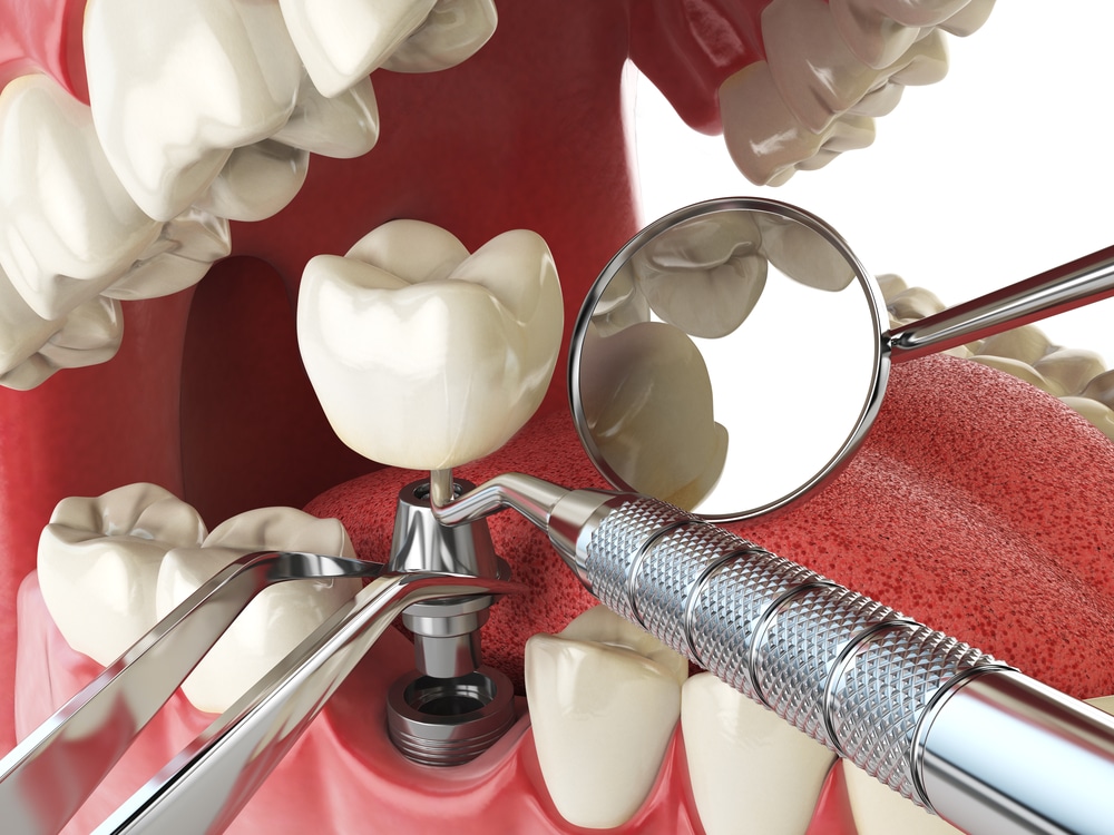 Dental Implants Dental Solutions of Mississippi dentist in Canton MS Dr. Ruth Roach Morgan Dr. Jessica Morgan